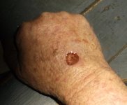 cancer-hand.jpg