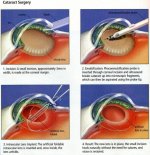 cataract.jpg