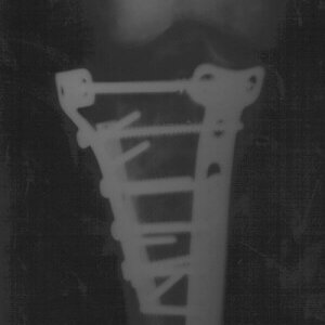 knee