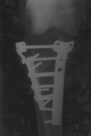 knee